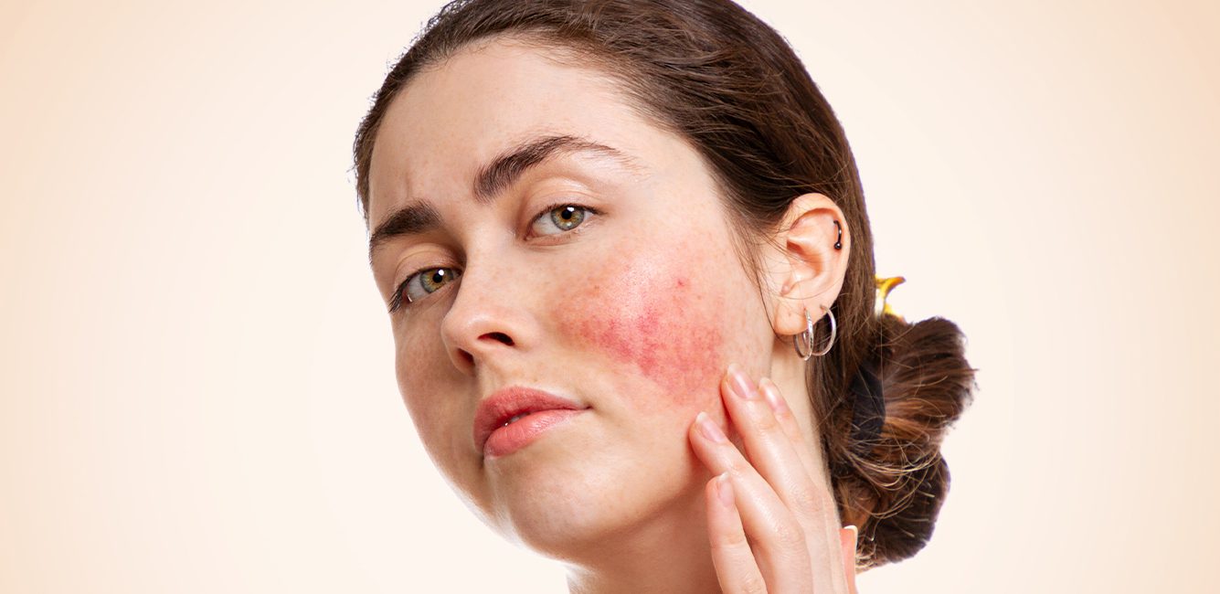 Symptoms, Triggers, and Treatment Options