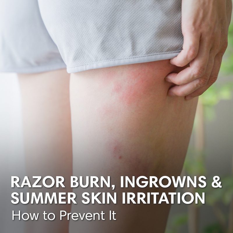 Razor Burn, Ingrown Hairs, and Summer Skin Irritation (Oh My!) 